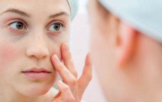 Effect of zinc gluconate on propionibacterium acnes resistance to erythromycin in patients with inflammatory acne