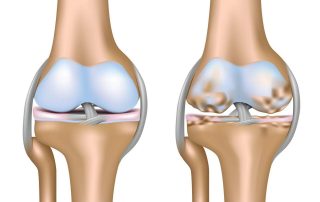 Effect of a glucosamine based combination supplement containing chondroitin sulfate and antioxidant micronutrients in subjects with symptomatic knee osteoarthritis